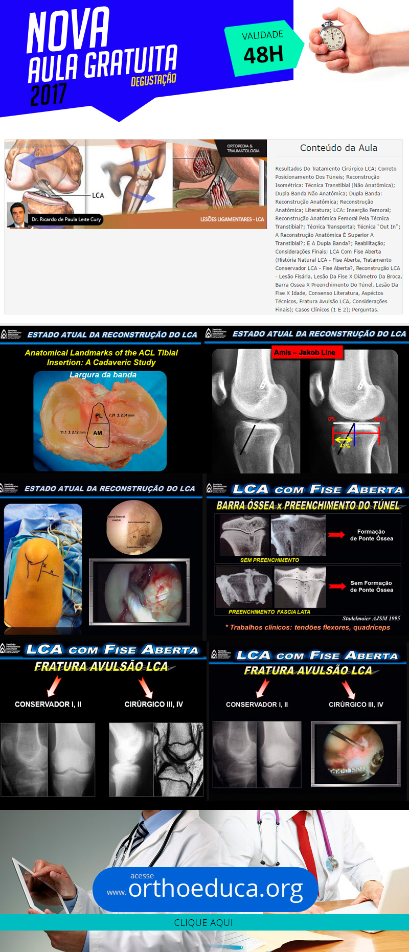 Lesões Ligamentares: LCA (Estado Atual da Reconstrução do LCA) (aula degustação grátis)