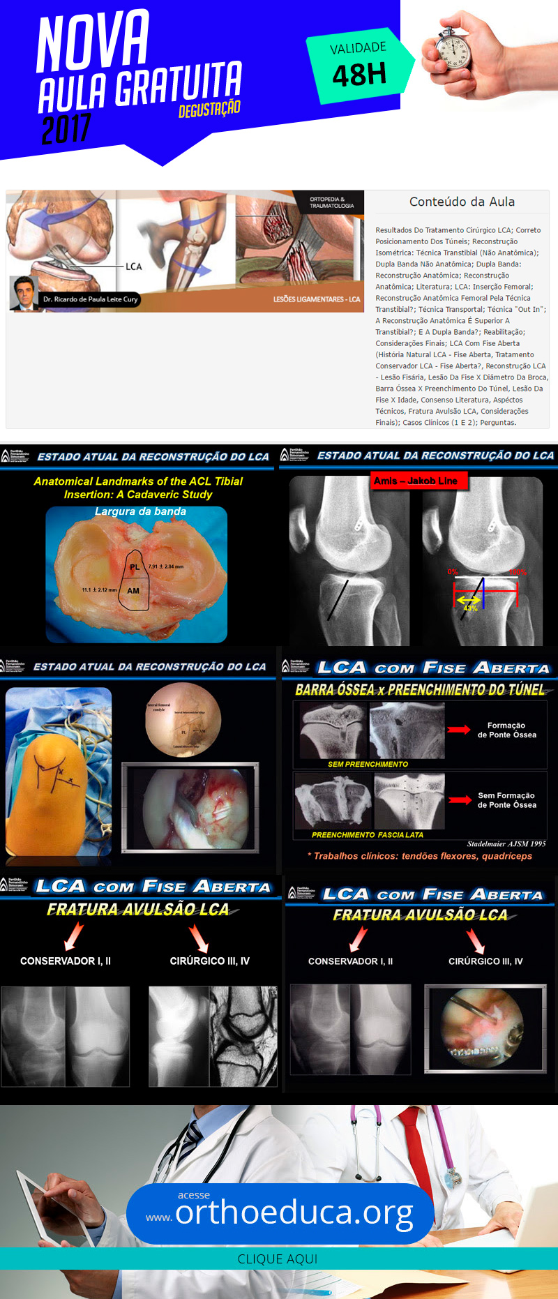 Leses Ligamentares: LCA (Estado Atual da Reconstruo do LCA) (aula degustao grtis)