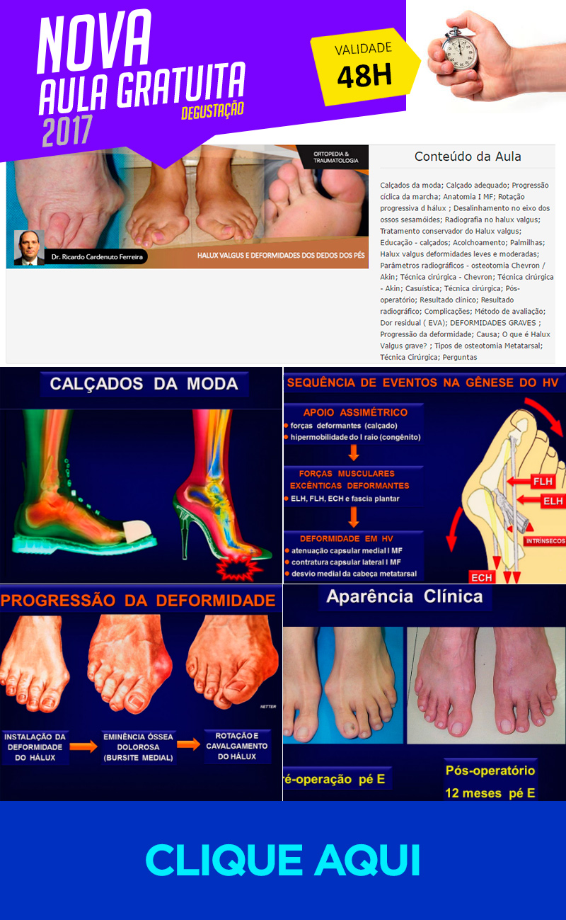 Hallux Valgus e Deformidades dos Dedos dos Ps (aula degustao grtis)