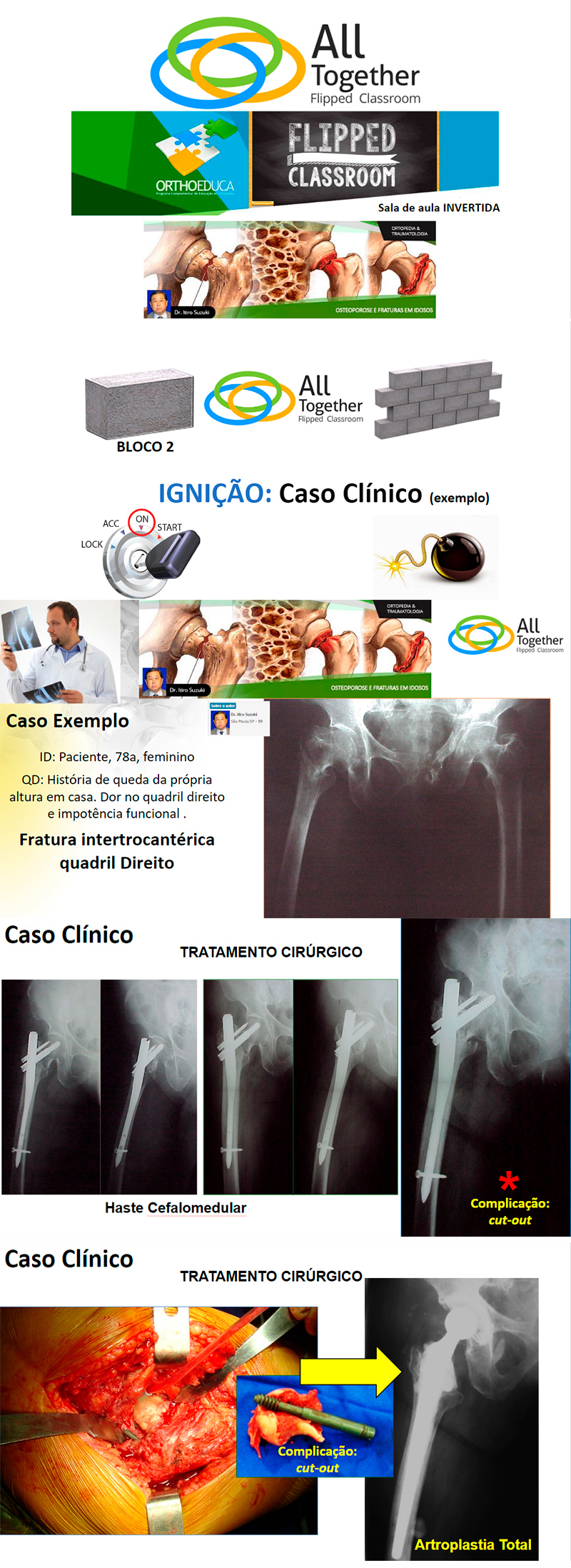 Osteoporose e Fraturas em Idosos - Caso clnico de hoje no All Together s 12h Participe!