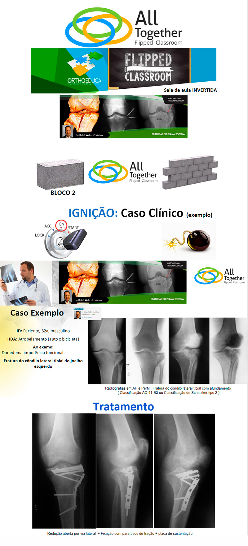 Fraturas do Planalto Tibial - Caso clínico de hoje no All Together às 12h50 - Participe! Fraturas do Planalto Tibial - Caso clínico de hoje no All Together às 12h50 - Participe!