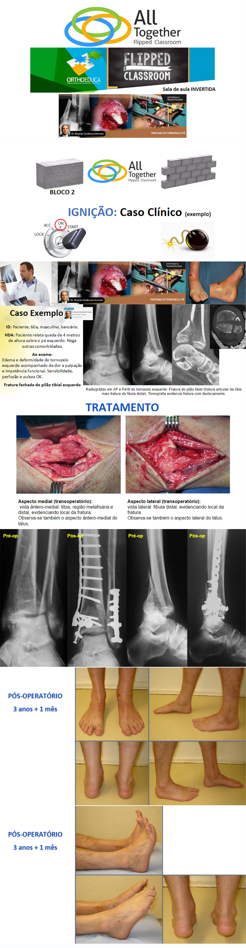 Fraturas do Tornozelo e Pé: Pilão Tibial - Caso clínico de hoje no All Together às 17h Fraturas do Tornozelo e Pé: Pilão Tibial - Caso clínico de hoje no All Together às 17h