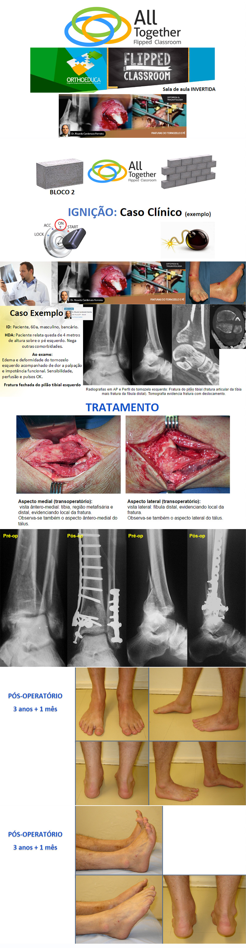 Fraturas do Tornozelo e P: Pilo Tibial - Caso clnico de hoje no All Together s 17h