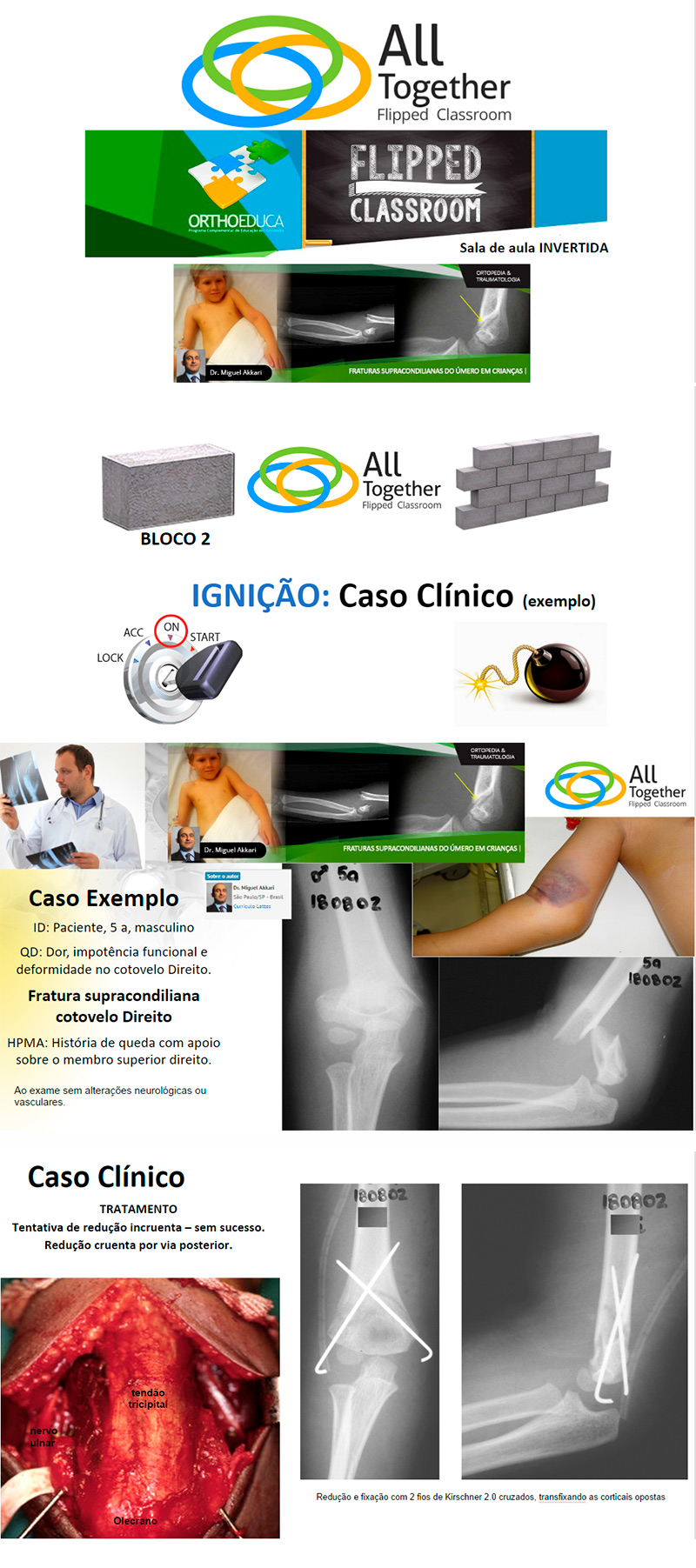 Fraturas Supracondilianas do Úmero em Crianças - Caso clínico de hoje no All Together às 12h Participe! Fraturas Supracondilianas do Úmero em Crianças - Caso clínico de hoje no All Together às 12h Participe!