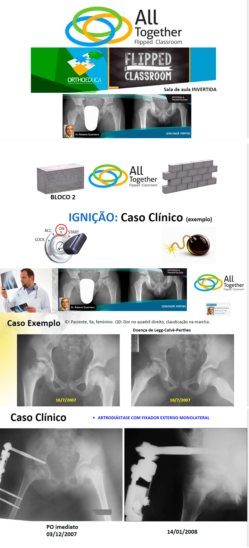 Legg-Calvè-Perthes - Caso clínico de hoje no All Together às 12h Participe! Legg-Calvè-Perthes - Caso clínico de hoje no All Together às 12h Participe!