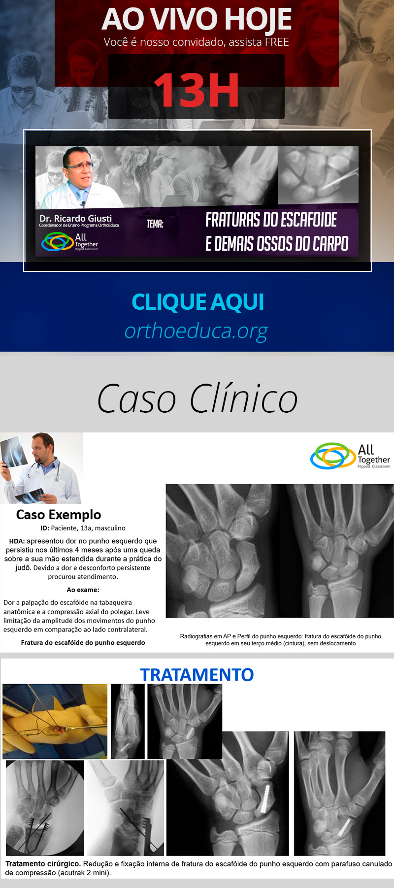 Fraturas do Escafoide e Demais Ossos do Carpo - Daqui a Pouco as 13h - Assista AO VIVO FREE! Fraturas do Escafoide e Demais Ossos do Carpo - Daqui a Pouco as 13h - Assista AO VIVO FREE!