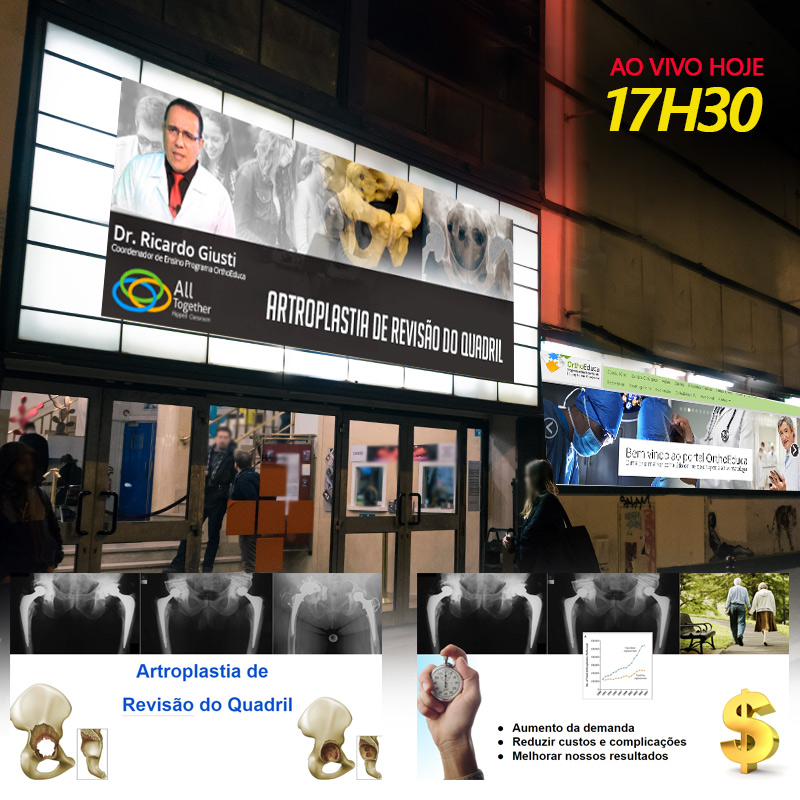 Artroplastia de Reviso do Quadril - AO VIVO 17h30min - Participe!