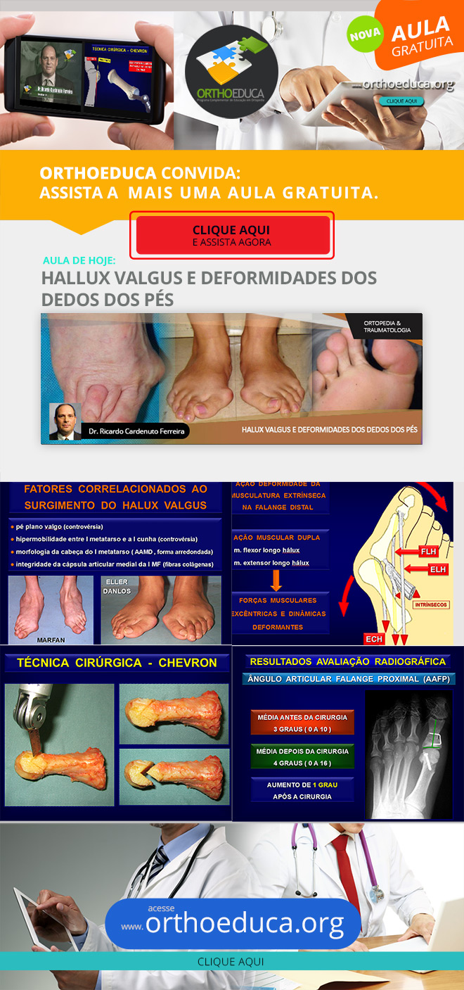 OrthoEduca Convida - Assista Hoje GRTIS: Hallux Valgus e Deformidades dos Dedos dos Ps