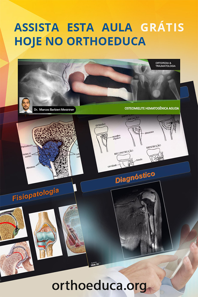 OrthoEduca Convida - Assista Hoje GRTIS: Osteomielite Hematognica Aguda