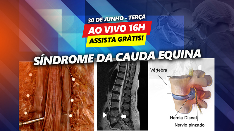 Sndrome da Cauda Equina - Assista agora grtis no ondemand!