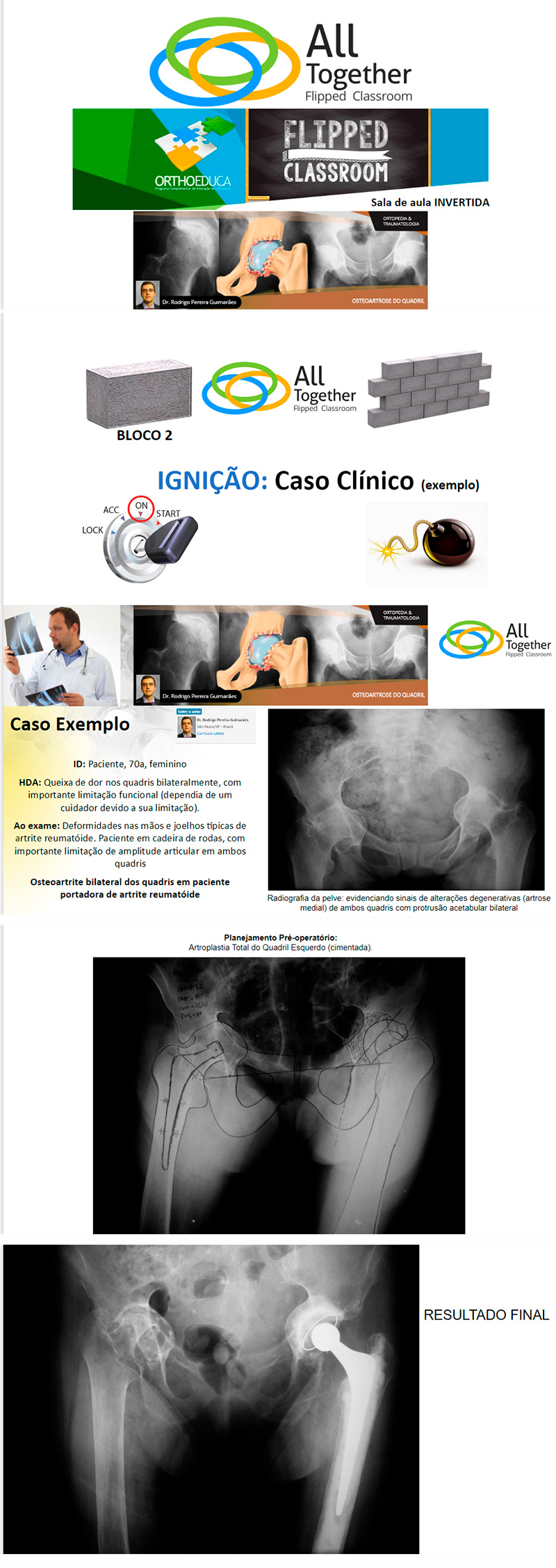 Osteoartrose do Quadril - Caso clínico de hoje no All Together às 17h Osteoartrose do Quadril - Caso clínico de hoje no All Together às 17h
