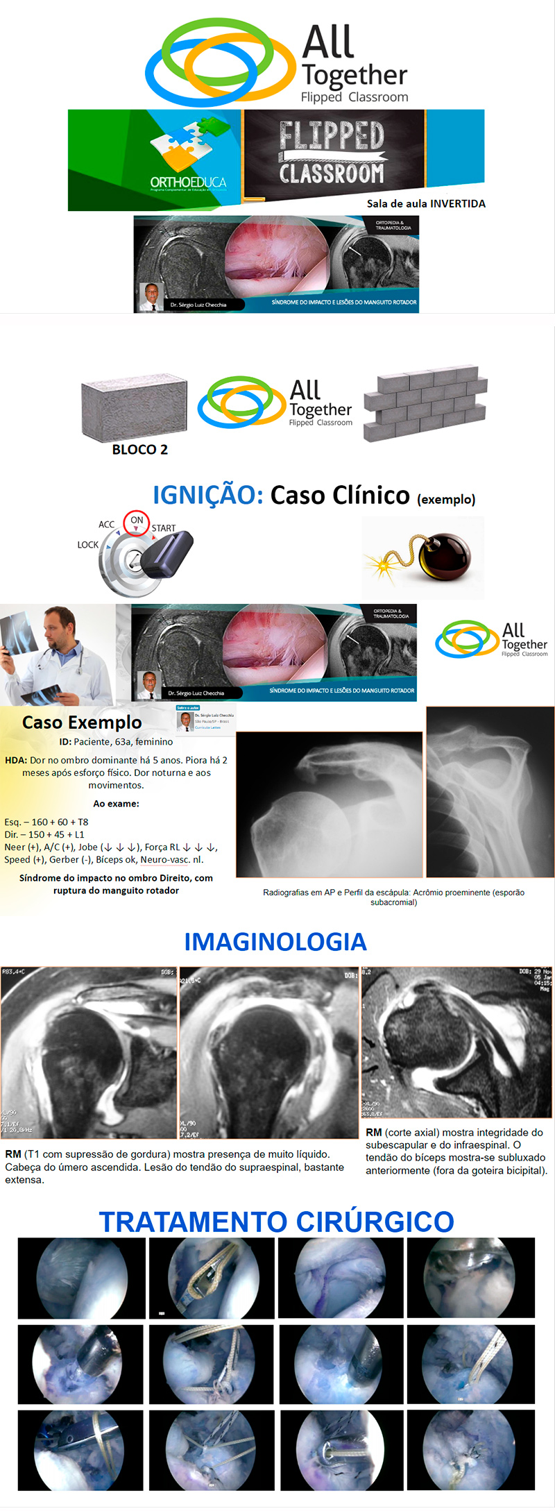 Síndrome do Impacto e Lesões do Manguito Rotador - Caso clínico de hoje no All Together às 12h50 Síndrome do Impacto e Lesões do Manguito Rotador - Caso clínico de hoje no All Together às 12h50