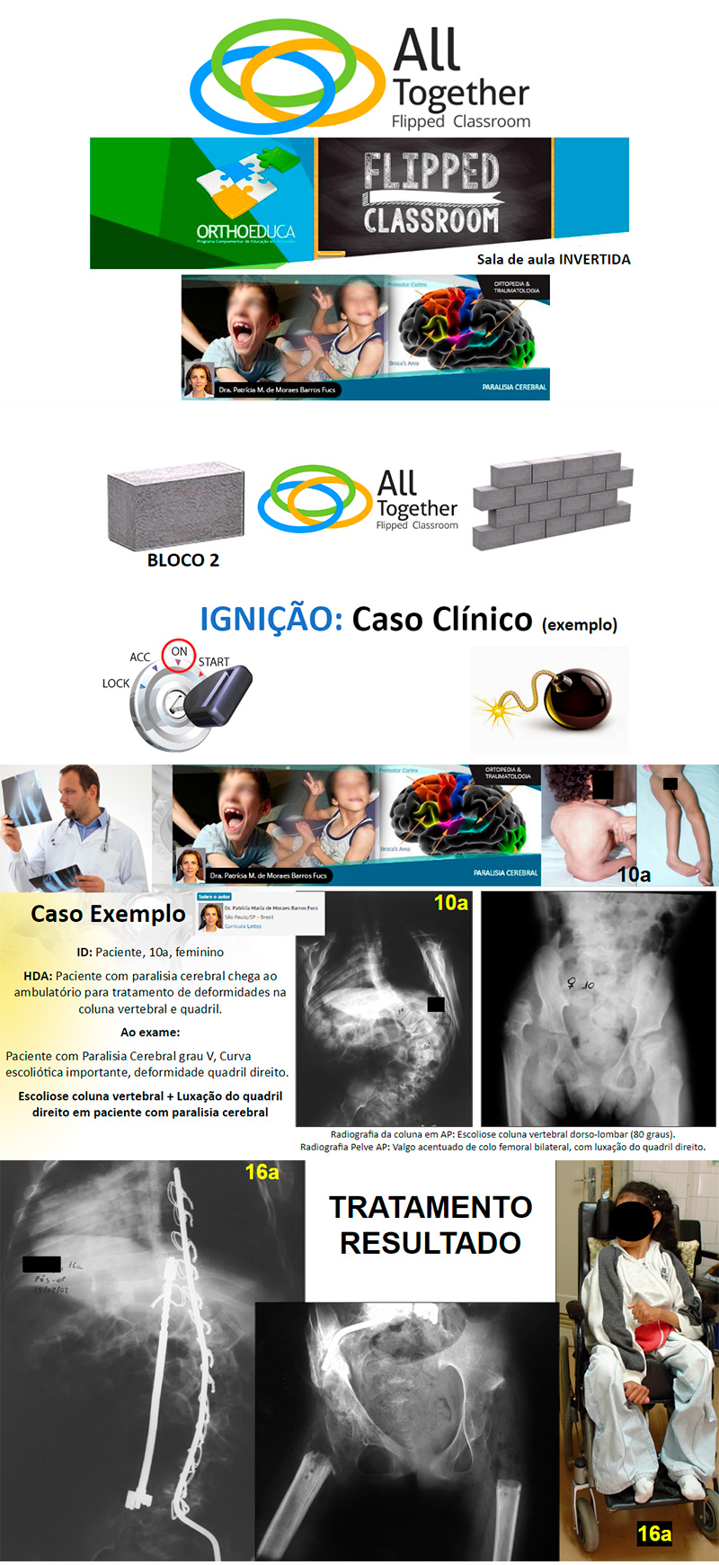 Paralisia Cerebral - Caso clínico de hoje no All Together às 17h Paralisia Cerebral - Caso clínico de hoje no All Together às 17h