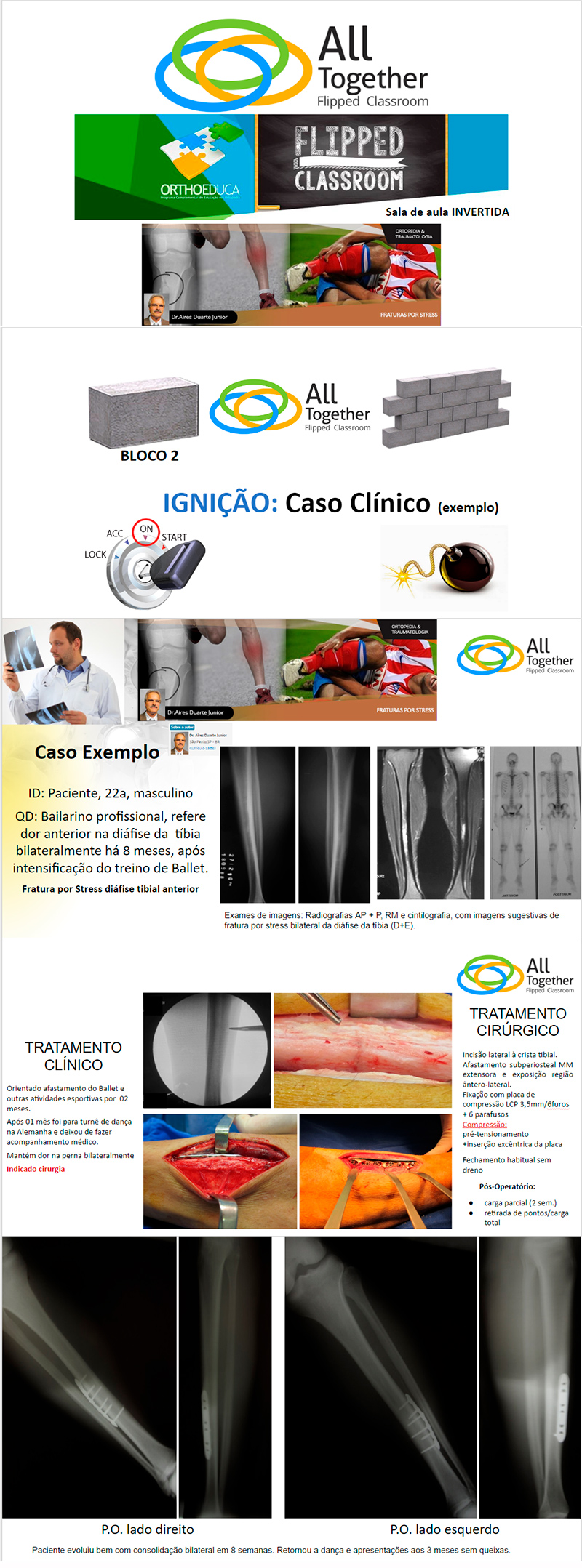 Fraturas por Stress - Caso clínico de hoje no All Together às 12h10 Participe! Fraturas por Stress - Caso clínico de hoje no All Together às 12h10 Participe!