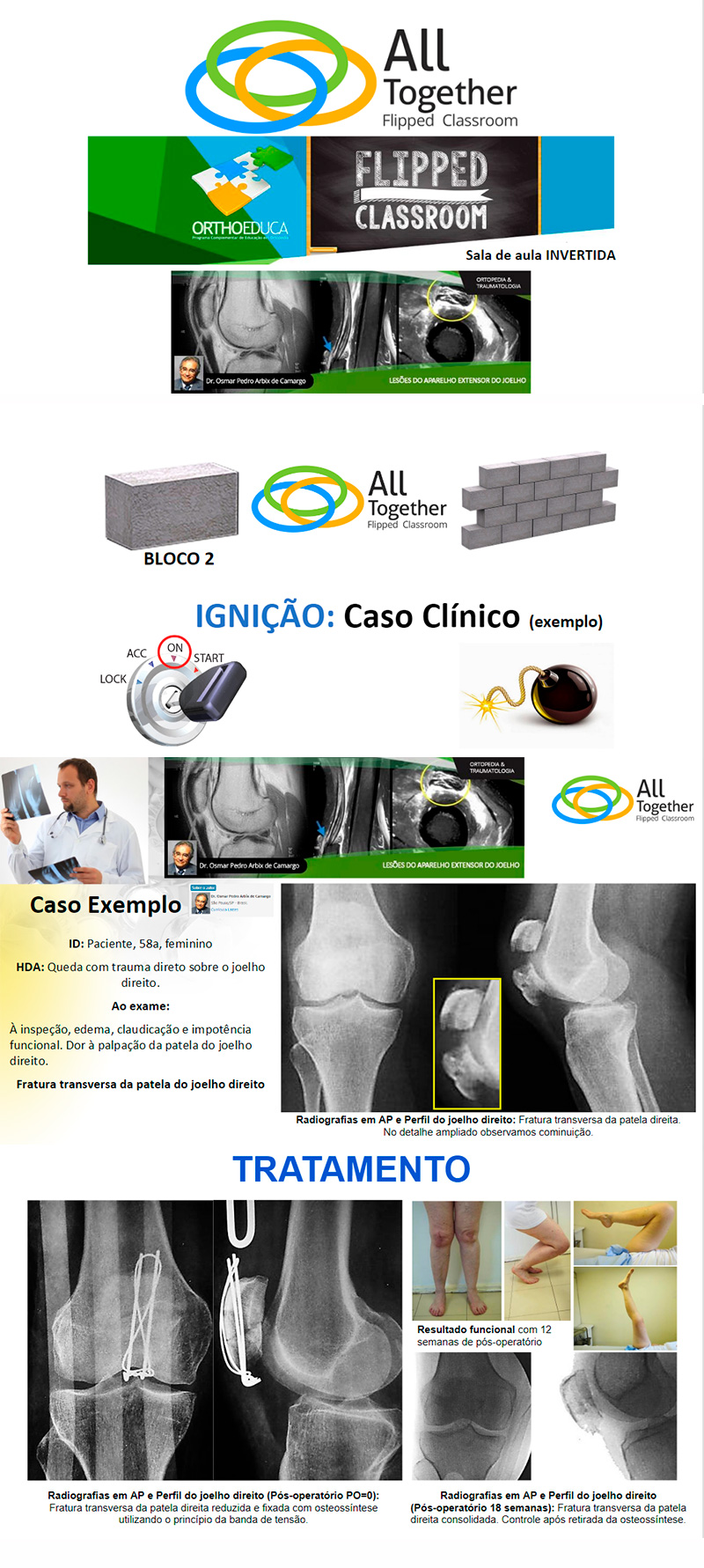 Leses do Aparelho Extensor do Joelho - Voc  nosso convidado hoje s 17h - Assista FREE