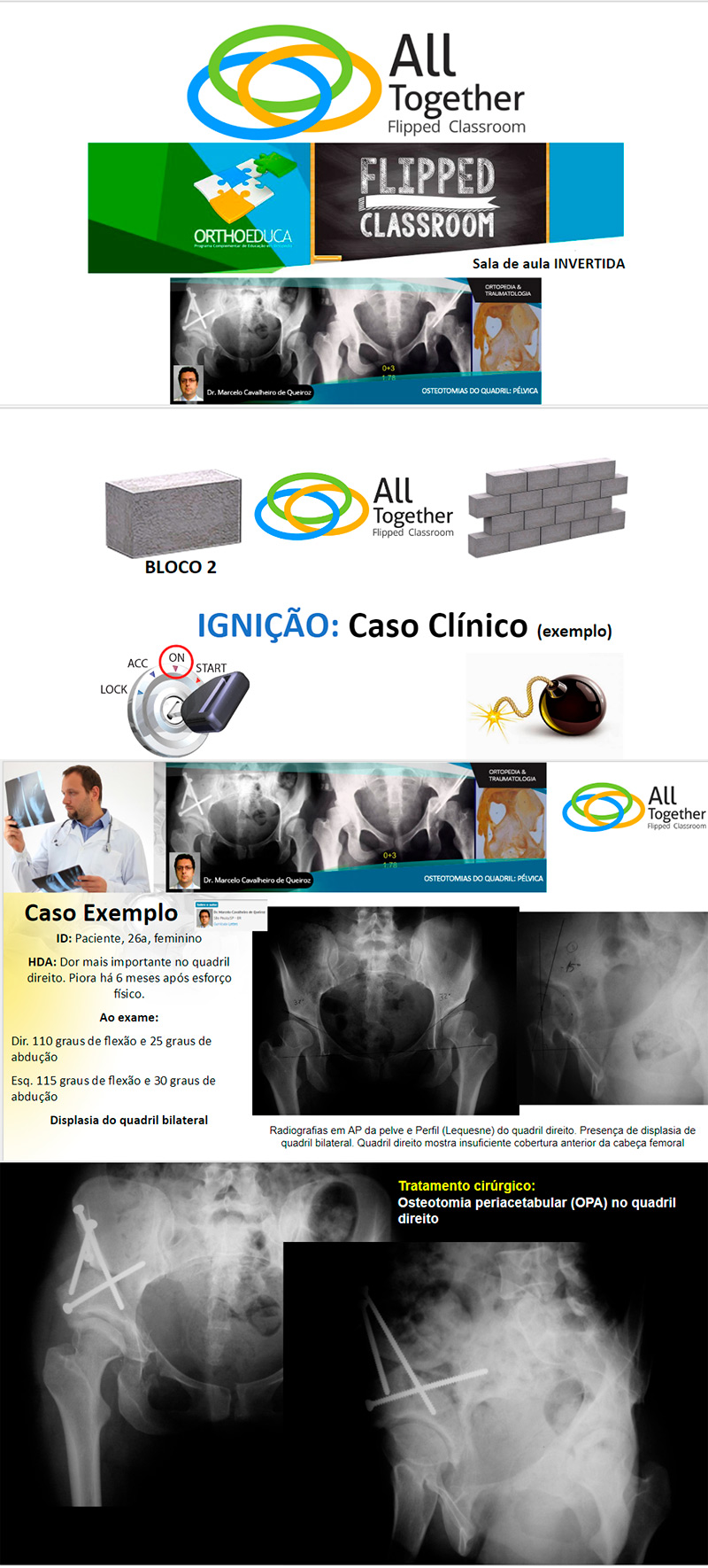 Daqui a pouco as 12h30min - Osteotomias do Quadril: Pélvica Daqui a pouco as 12h30min - Osteotomias do Quadril: Pélvica