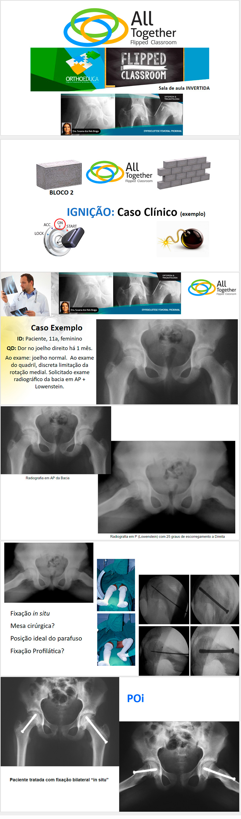 Epifisiolistese Femoral Proximal - Caso clínico de hoje no All Together às 12h Participe! Epifisiolistese Femoral Proximal - Caso clínico de hoje no All Together às 12h Participe!