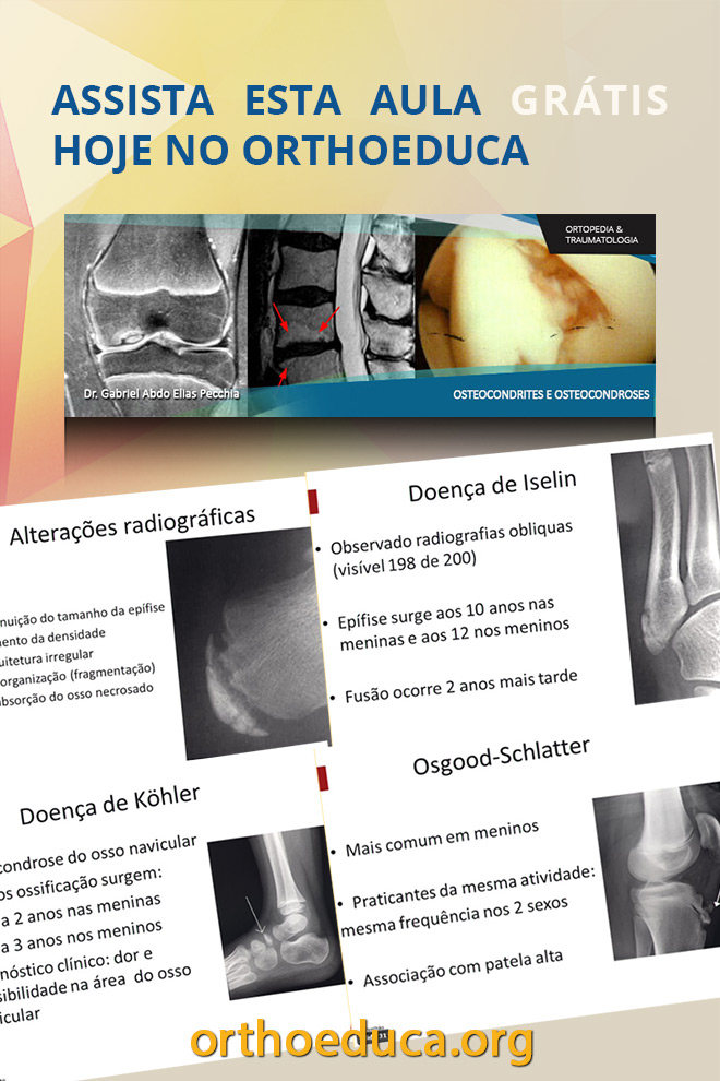 OrthoEduca Convida - Assista Hoje GRTIS: Osteocondrites e Osteocondroses