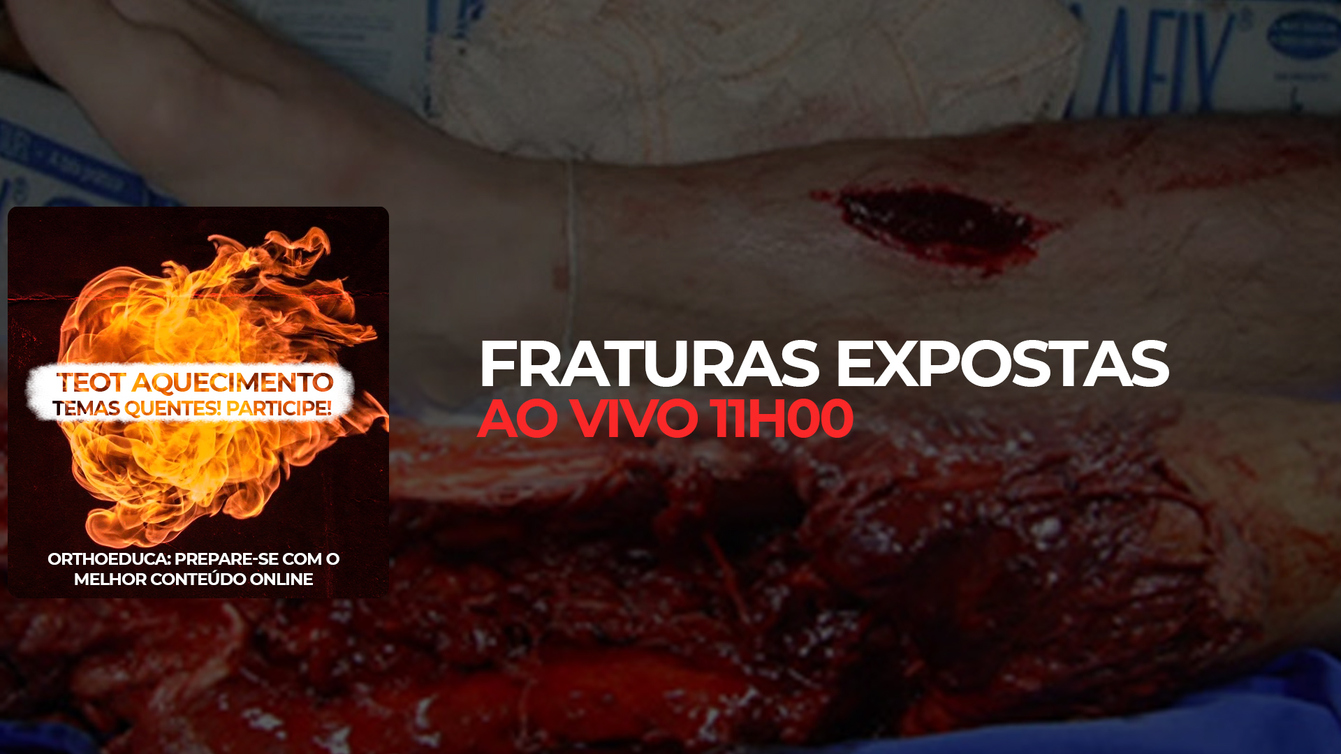 TEOT Aquecimento: Fraturas Expostas. Hoje s 11h no OrthoEduca. Assista grtis! Participe