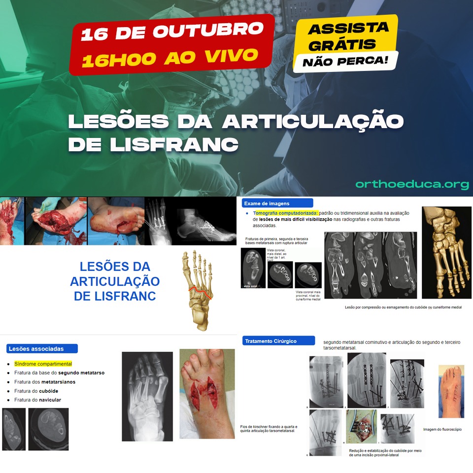 Teot aquecimento: Leses da Articulao de Lisfranc ao vivo hoje s 16h